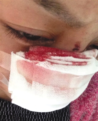 　李云鼻子被割后仍在治療。網(wǎng)絡(luò)截圖